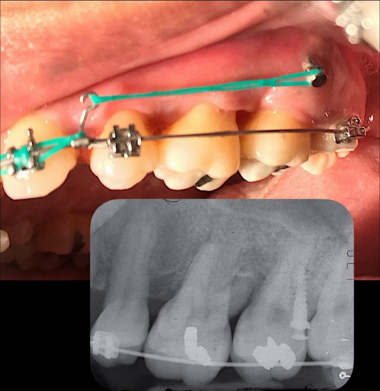 ถ้าเจอฟันที่เป็น Perio แบบ Questionable prognosis ควรหยุดจัดฟันไหม ?