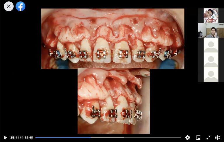 ความสำคัญของ Perio – Ortho กับประสบการณ์ไปบรรยาย ในคอร์ส OLL