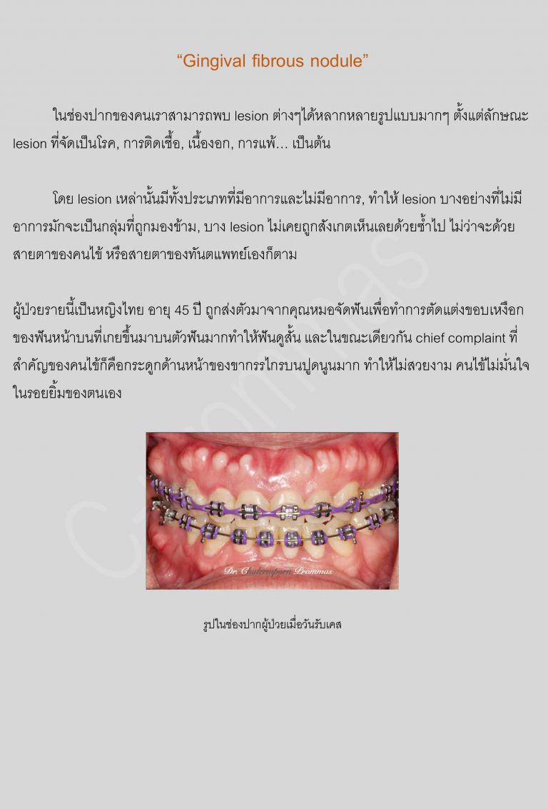 Gingival fibrous nodule