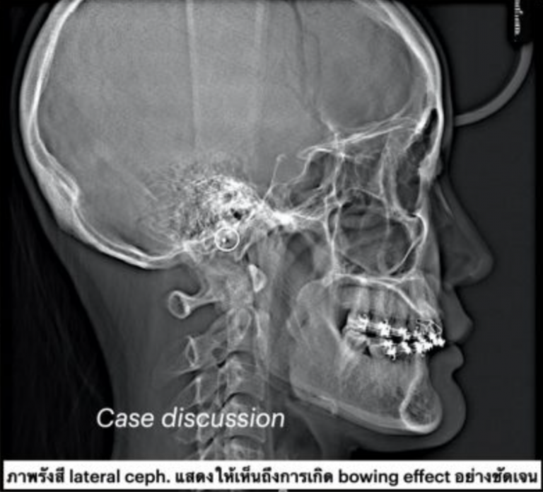 Orthodontic tx & Gummy Smile