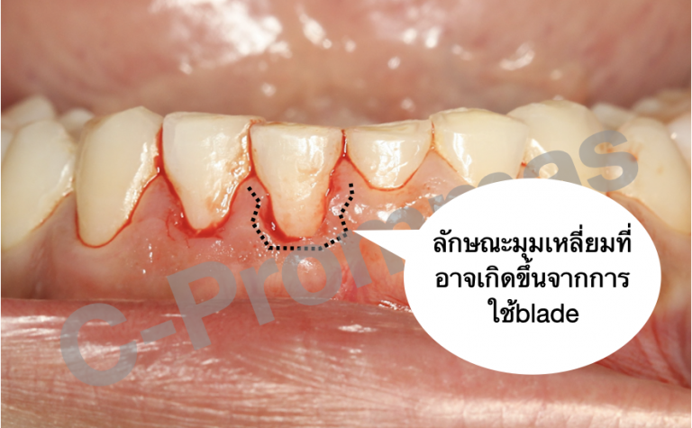 Blade vs Electrosurgery vs (Diode) laser??