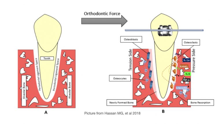 ฟันโยกกับการจัดฟัน