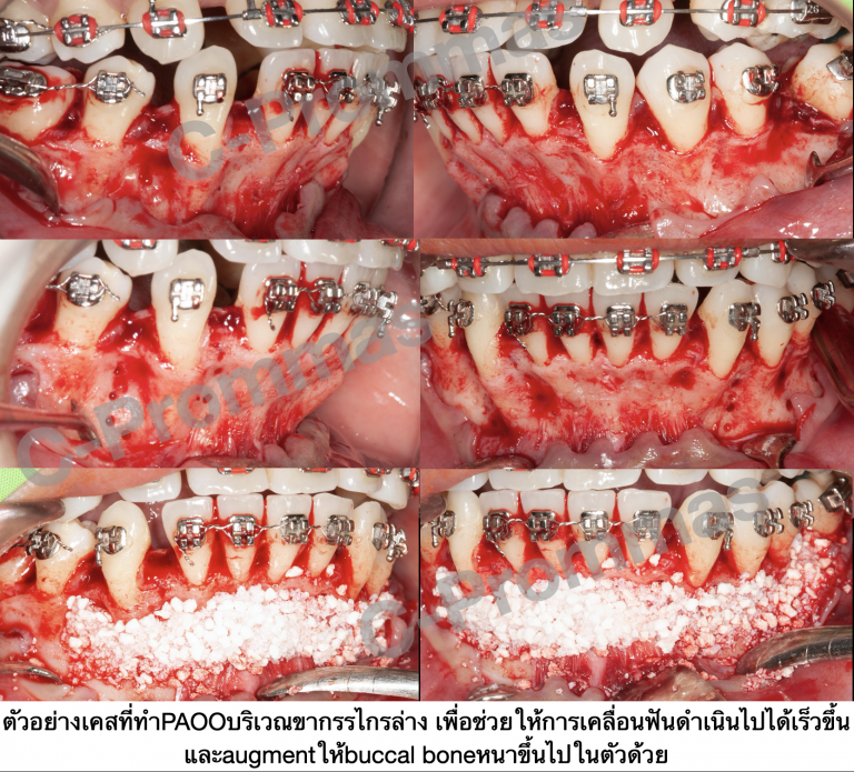 Periodontally Accelerated Osteogenic Orthodontics