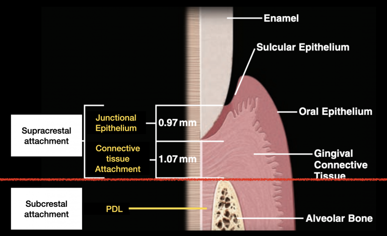 การทำFiberotomyเพื่อแก้ไขการคืนกลับของฟันที่ผ่านการแก้ไขฟันบิดหมุน